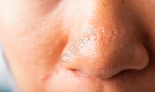毛孔出大女人大的毛孔有雀斑脸颊油润滑 鼻子上刺鼻白头美容成人女孩皮肤科斑点腺体皮脂疙瘩治疗背景