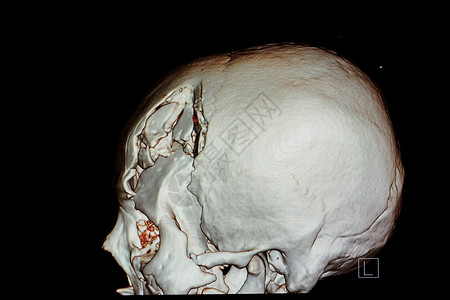 神经外科素材脑外伤患者头骨的 3D 渲染胶片疾病药品医生外科颅骨解剖学创伤诊断轨道医院背景