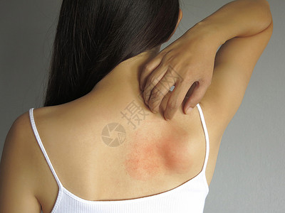 痱子关紧身的年轻女人用过敏性皮疹痒痒地抓着她的背部背景