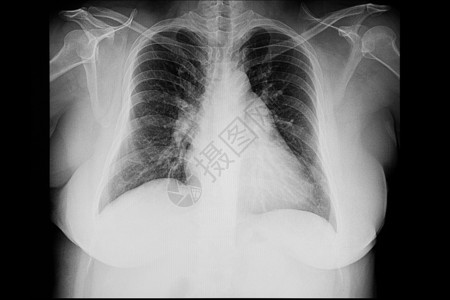 胸腔积液心脏病解剖学医院放射科胸部诊断骨骼x光病人射线胸膜背景