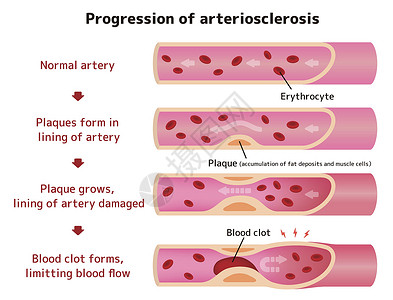 血栓弹力图动脉硬化它制作图案的进展中风血栓血管压力静脉细胞外科封锁牌匾科学插画