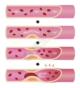 心血管疾病血管动脉硬化它制作图案的进展手术插图心血管封锁梗死流动身体血管动脉心肌插画