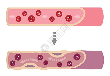 血管细胞健康血液因各种不健康因素导致动脉硬化而变得浑浊的例证科学疾病载体静脉中风梗死动脉解剖学攻击插图插画
