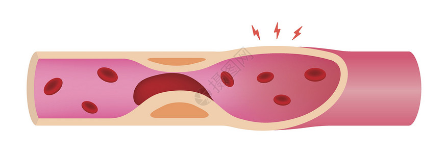 动脉粥样硬化它制作图案被血块堵塞的动脉插画