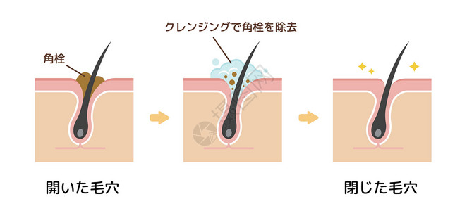 洁面皂毛孔结构示意图 清除角质栓塞白头 清洁后的黑头表皮化妆品治疗擦洗卡通片插图载体头发细胞气泡插画