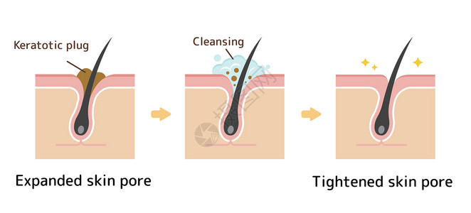 皮肤角质毛孔结构示意图 清除角质栓塞白头 清洁后的黑头细胞擦洗组织治疗表皮图表洁面头发载体解剖学插画