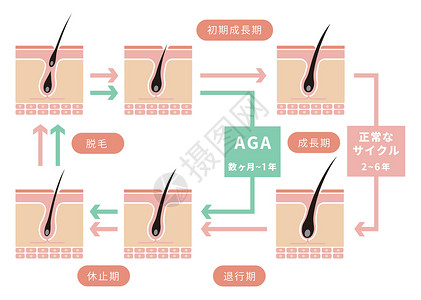 脂溢性脱发头皮电灯泡高清图片