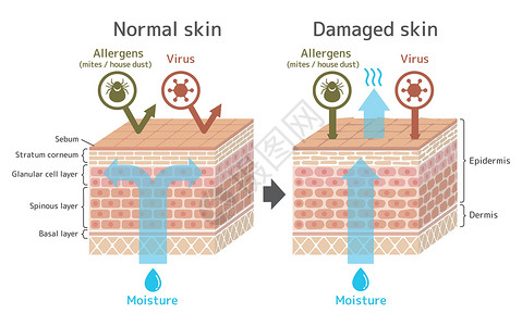 皮肤吸收水分皮肤剖面图 健康皮肤与受伤滑雪者保护效果对比图损害细胞细菌学校药品绘画皮脂卫生真皮水分插画