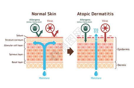 特应性皮炎和正常皮肤比较的截面图卫生疼痛病人湿疹过敏皮肤科解剖学表皮治疗保健插画