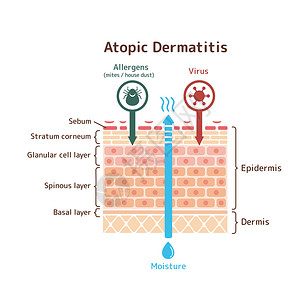过敏性皮炎特应性皮炎载体它制作图案的剖面图瘙痒疾病皮肤剥皮症状卫生身体皮炎插图湿疹插画
