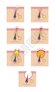 Acne类型和递进说明编队生物学粉刺皮脂护理皮肤载体头发疙瘩卵泡背景图片