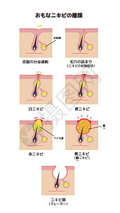 Acne类型和递进说明卵泡痤疮疾病头发女士陨石皮脂身体生物学护理背景图片