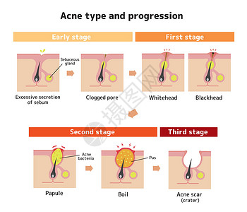 Acne类型和递进说明皮肤编队治疗真皮生物学细胞皮脂腺身体白头插图背景图片