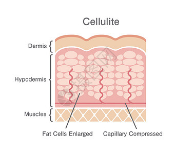 团灭脂肪团皮肤它制作图案组织身体图表绘画插图饮食护理真皮卫生编队设计图片