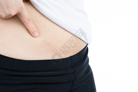 激光祛疤近距离检查显示腹部有伤疤的妇女 因为腹部的外科手术在白色背景上隔离 健康护理和医疗概念背景