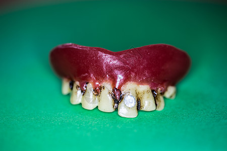 上下巴假牙的假牙下颌牙印植入物部分牙科门牙修复术假肢治疗牙医背景图片
