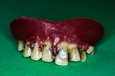 上下巴假牙的假牙下颌牙齿牙列上颚牙医修复术维修门牙臼齿假肢背景图片