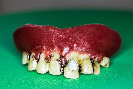 上下巴假牙的假牙维修下颌植入物臼齿假肢上颚牙印门牙修复术牙医背景图片
