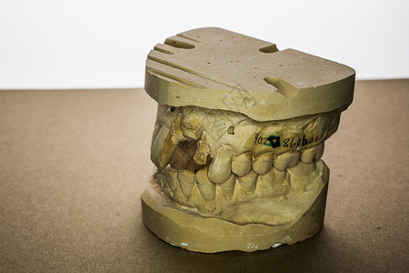 假印花修复术牙科上颚治疗植入物下颌牙医假牙部分门牙背景图片