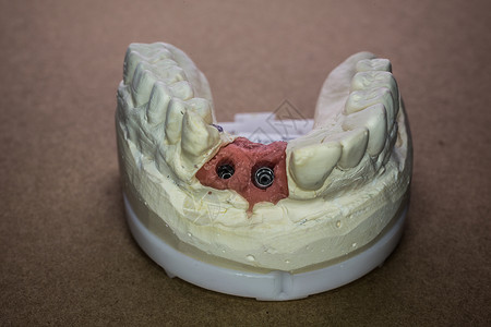 假印花上颚植入物门牙牙医治疗假肢牙列牙印牙齿臼齿背景图片