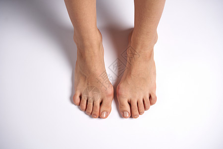 足外翻女性双腿上事故状况痛苦药品解剖学脚趾疗法整脊疼痛指甲背景