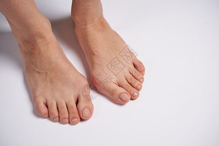 脚趾外翻女性双腿上的紧贴在白色背景上畸形外翻治疗状况手指病人保健疼痛骨科疾病背景