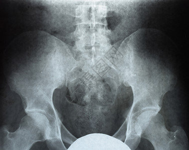 强直性脊柱炎X光 骨盆和Sacrum的X光科学腰椎诊断强直性考试技术骶骨药品病人骨科背景