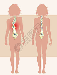 患有骨质疏松症的女童药品脊椎疼痛骨头解剖学脊柱插图神经关节女士背景图片