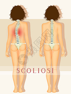 骨质疏松插图药品腰椎疼痛骨头风湿病椎骨脱位女士尾骨脊柱背景图片