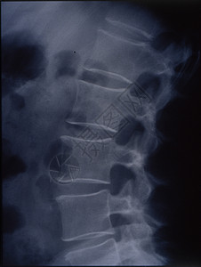 用于医学诊断的脊椎X光图像椎体射线扫描x光骨骼骨架脊髓考试药品医生背景