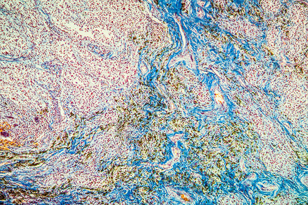 巨细胞显微术结节病高清图片