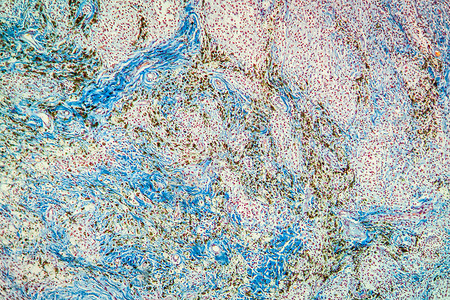 显微镜下外体颗粒瘤组织 100x细胞科学疾病放大镜巨细胞蓝色异物皮肤宏观病变背景