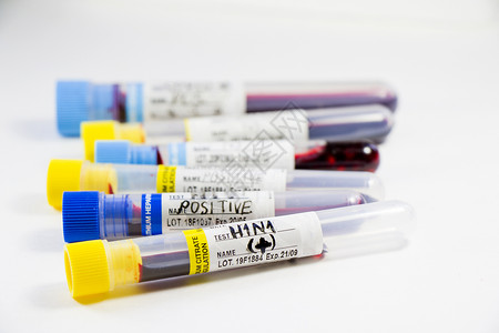 H1N1猪流感 诊断和化验 血液测试管样本 文本和信件技术治疗感染细菌感染发烧唱歌症状血液学药剂预防背景图片