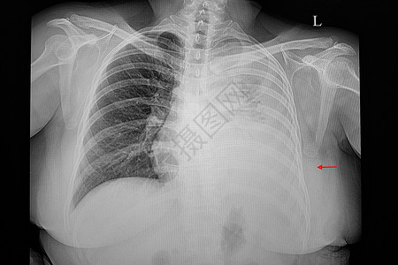 鞘膜积液胸部X光片 一个病人的胸透膜 巨大的胸腔充血背景