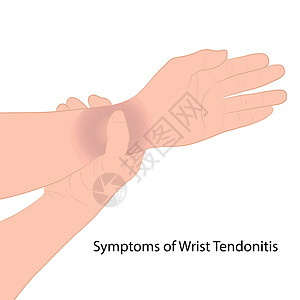 突然醒悟图像图形矢量轮廓手腕疼痛通常是由突然受伤概念保健引起的扭伤或骨折引起的诊所骨头茎突医师菌株韧带身体教育插图手臂设计图片