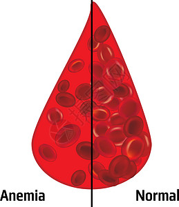 小儿贫血贫血和正常红血细胞沉积诊断治愈血液学红细胞愈合疾病诊所实验室血细胞验血设计图片