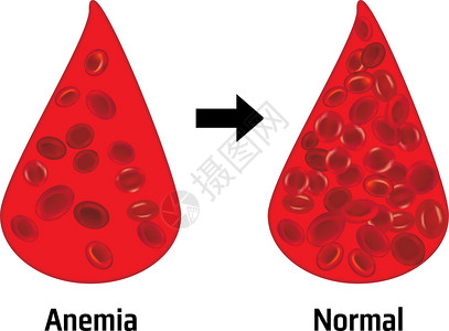 血和素材贫血和正常红血细胞沉积血细胞药品科学插图血液学生物愈合化学治愈生物学设计图片