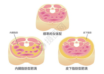 下半身日本的肥胖插图类型 腹部剖视图 内脏脂肪 皮下脂肪身体横截面医疗男性药品数字卫生糖尿病科学饮食插画