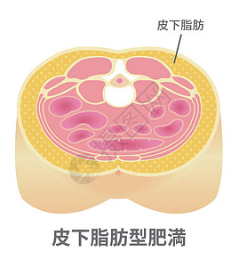 脂肪瘤日本的肥胖插图类型 腹部剖视图皮下脂肪疾病身体糖尿病重量医疗男性代谢生物学科学数字插画