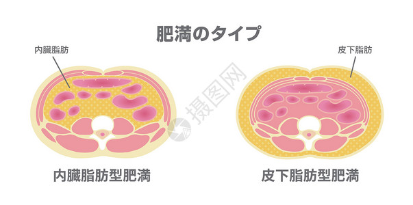 日本的肥胖插图类型 腹部剖视图 内脏脂肪 皮下脂肪器官卫生饮食重量生物学男性男人疾病医疗横截面插画