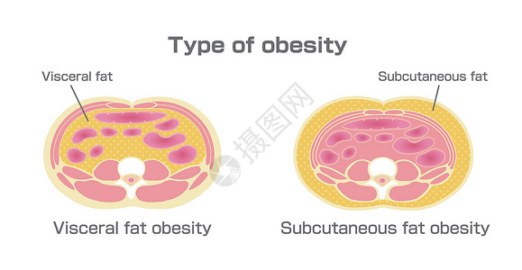 日本的肥胖插图类型 腹部剖视图 内脏脂肪 皮下脂肪男性身体卫生糖尿病疾病保健生物学数字科学重量插画