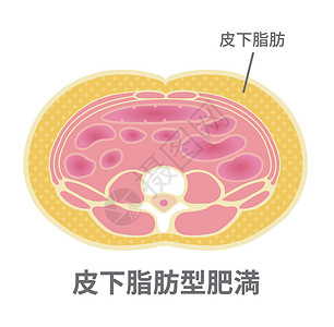 脂肪瘤日本的肥胖插图类型 腹部剖视图皮下脂肪药品卫生重量器官科学保健男性男人生物学代谢插画