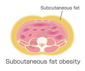 脂肪瘤日本的肥胖插图类型 腹部剖视图皮下脂肪数字器官饮食药品代谢医疗科学损失生物学疾病插画