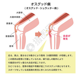 掌腱肌病膝关节病它制作图案伤害器官股骨疾病解剖学疼痛膝盖身体胫骨髌腱插画