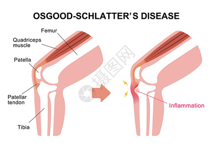 施普利瓦尔德病膝关节病它制作图案插图伤害疾病骨骼肌腱髌腱髌骨生物学解剖学软骨插画