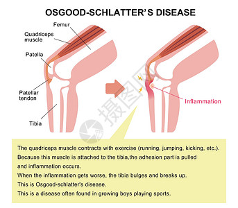 掌腱肌病膝关节病它制作图案髌骨膝盖解剖学插图股骨骨骼疾病运动疼痛治疗插画