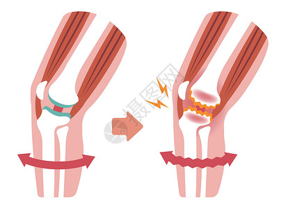 根尖炎膝关节疼痛的机制和原因 膝关节炎 骨关节炎 膝关节 平面插图替代品器官保健膝关节病药品疾病股骨节炎膝盖科学插画
