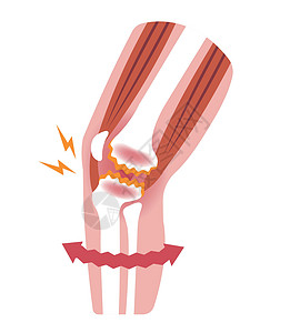女性户外运动受伤膝关节疼痛膝关节病骨关节炎膝关节病 平面插画卫生女性关节替代品解剖学生物学股骨病人插图保健插画