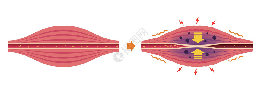 肌肉纤维肌肉僵硬和疼痛圆圈类型它制作图案的过程脖子身体组织痛苦疾病女士血管药品插图纤维插画