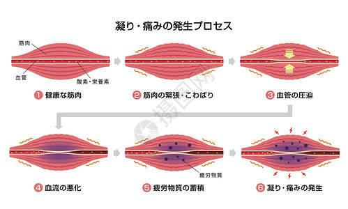 肌肉僵硬和疼痛圆圈类型它制作图案的过程痛苦解剖学插图脖子女士疾病身体按摩器官肩膀插画